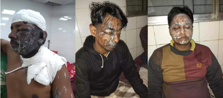 সদরপুরে এসিড নিক্ষেপের ঘটনায় ৩ জন গ্রেফতার